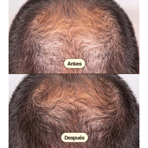 Freshly Cosmetics - Anti-hair loss treatment Hair Growth & Density