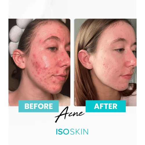 ISOCLEAN - *ISOSKIN* - Face and body spray Hypochlorous - 100ml