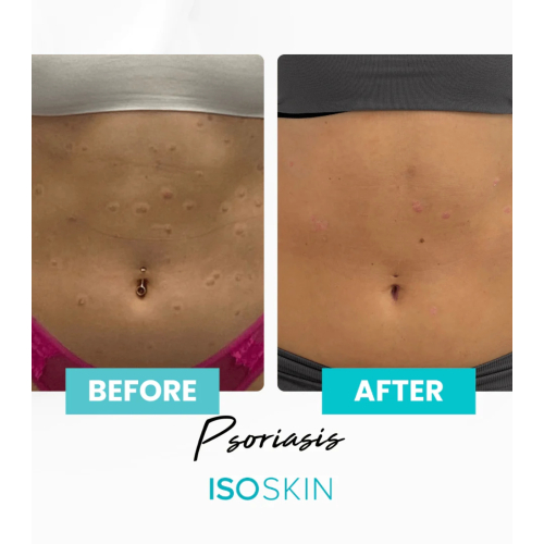 ISOCLEAN - *ISOSKIN* - Face and body spray Hypochlorous - 100ml