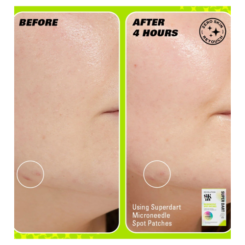Revolution Skin - Microneedle Pimple Patches with Salicylic Acid Super Dart