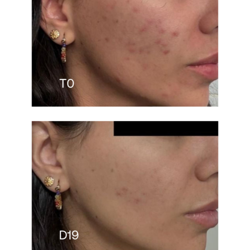 Sensilis - *Oily Skin* - Anti-blemish concentrate Pure 15AZ
